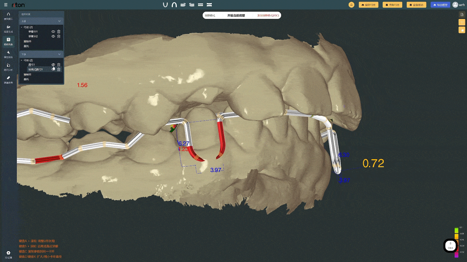 archwire occlusion interference analysis