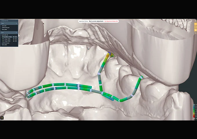 Archwire Occlusion Interference Analysis