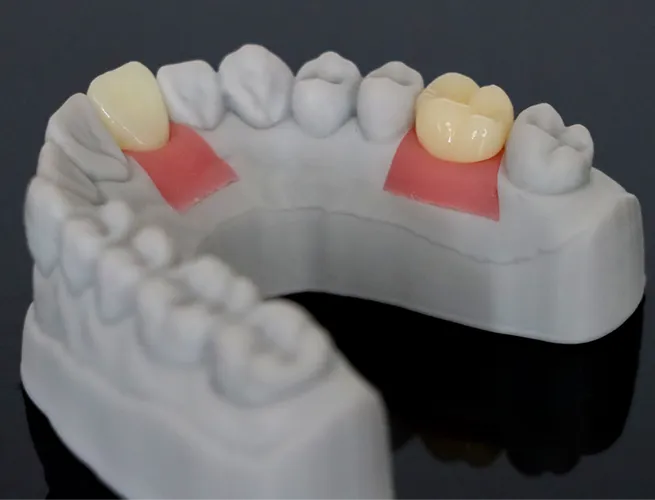 resin material gingiva mask sample 2