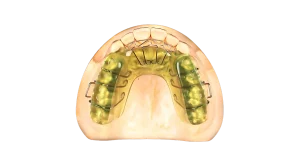 Tongue Shield Appliance