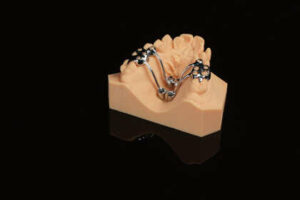 Rapid Palatal Expander (RPE)